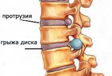 Photo of Межпозвоночная грыжа: причины, симптомы, диагностика