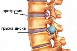 Photo of Межпозвоночная грыжа: причины, симптомы, диагностика